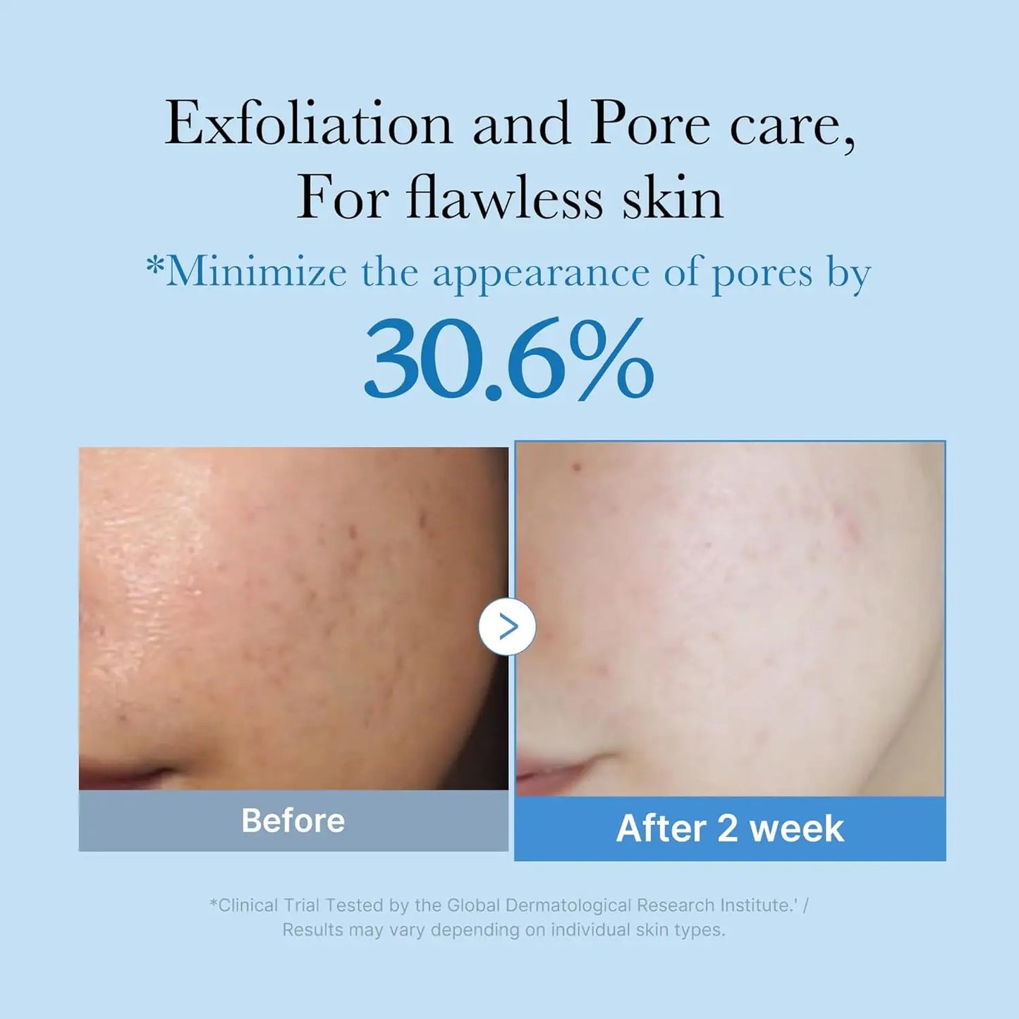 medicube Zero Pore Toner  Exfoliating  Hydrating Blue Bottle Water Toner with AHA   Korean Skin Care